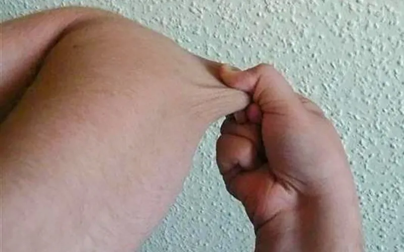 ND19_Ehlers-Danlos Syndrome3