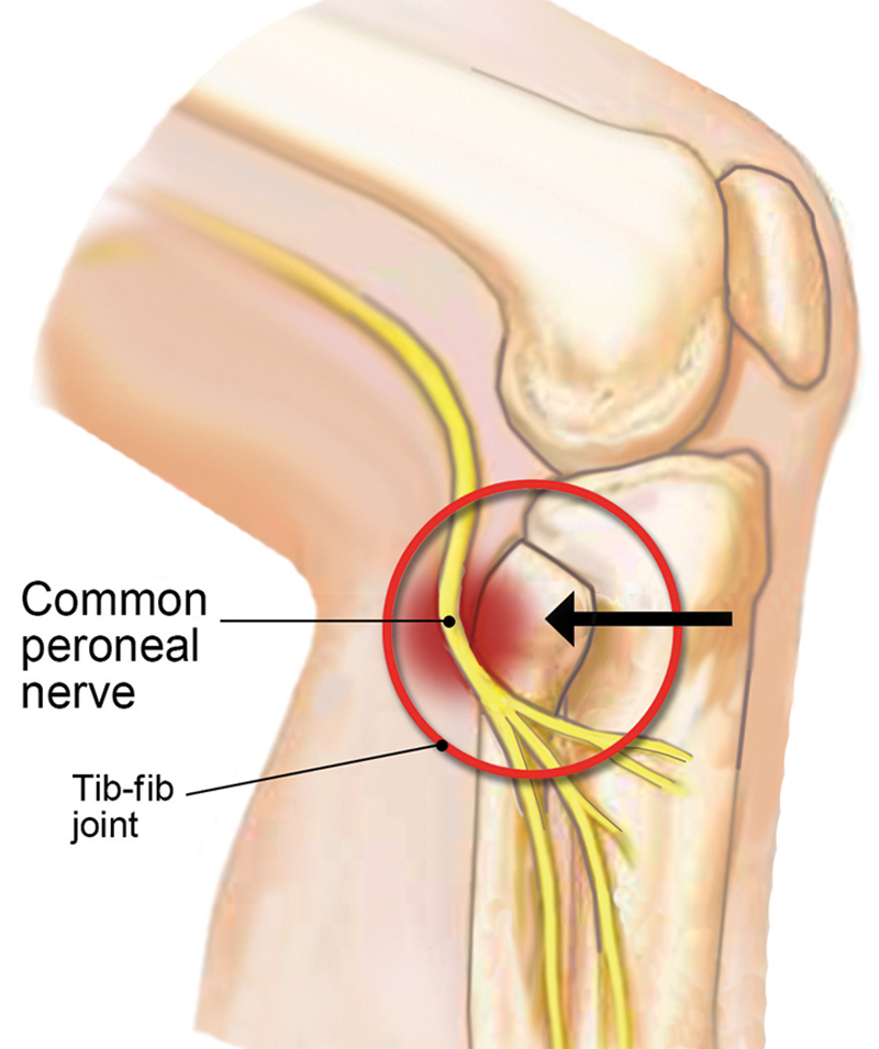 MJ20_Superior TibFib4